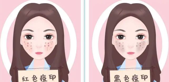 臉上紅色痘印幾個月都不消怎么辦？紅色痘印應(yīng)該怎么消除？