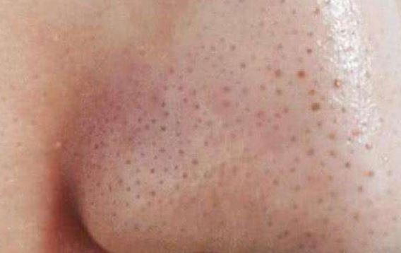 清潔面膜哪個牌子可以快速祛黑頭？趙薇、薇婭 推薦的紐西之謎泥膜真的好用嗎？